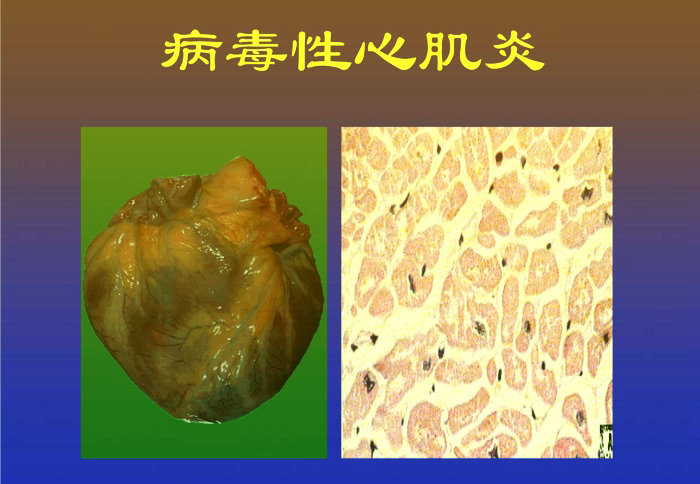 邓理斌——浅谈用几首古经方治疗病毒性心肌炎